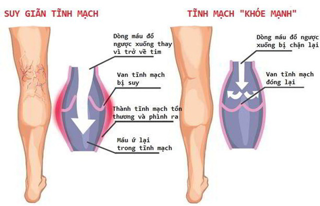 Chronic Venous Insufficiency - Hình ảnh minh họa
